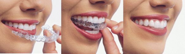 Капы для защиты зубов