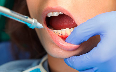 Местная анестезия в стоматологии: виды и краткое описание
