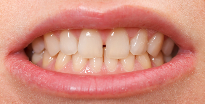 Как убрать щель между передними зубами: 10 способов