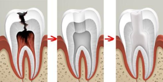 Почему болит зуб после удаления нерва?